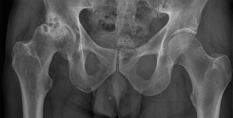 Arthrose de stade 3 de l'articulation de la hanche sur une radiographie