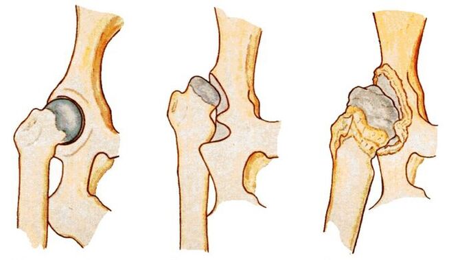 La dysplasie de la hanche est une cause de coxarthrose secondaire. 