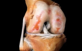 Qu'est-ce que l'arthrose de l'articulation du genou