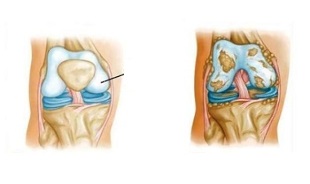 modifications pathologiques de l'arthrose du genou