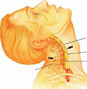 Ostéochondrose de la colonne cervicale. 