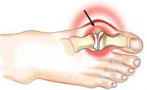 Gonflement de l'articulation entre le pouce et le pied dans l'arthrite. 