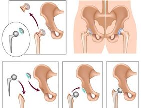 arthroplastie pour l'arthrose de la hanche