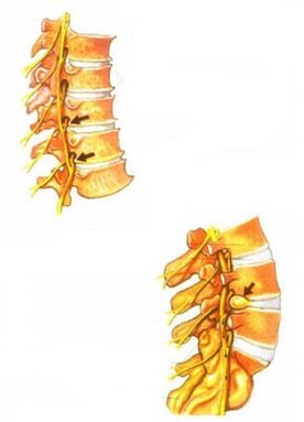 Illustration de l'ostéochondrose de la colonne vertébrale. 