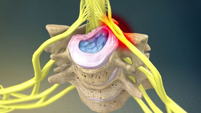 Le bombement du disque intervertébral est à l'origine de douleurs cervicales. 