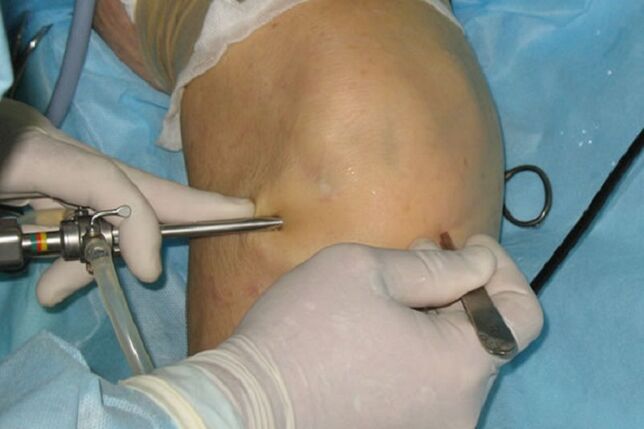 arthroscopie pour douleur au genou